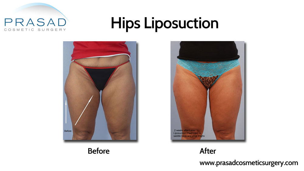 hips liposuction recovery