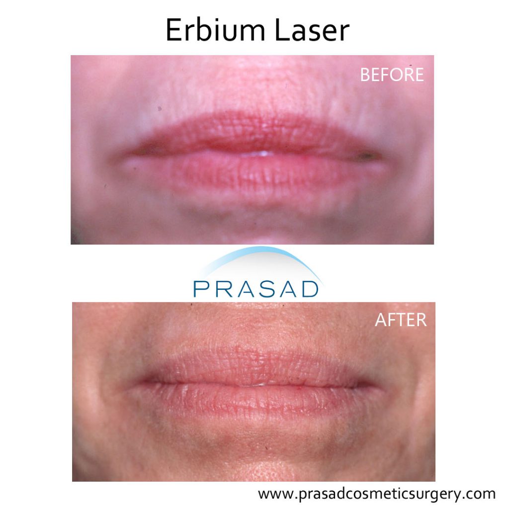 laser lip treatment before and after