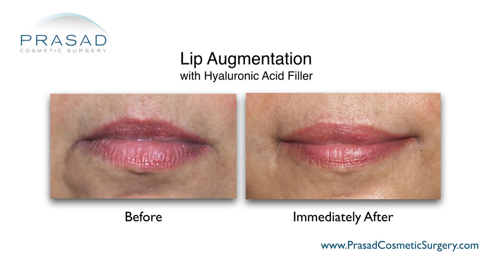 lip augmentation before and after