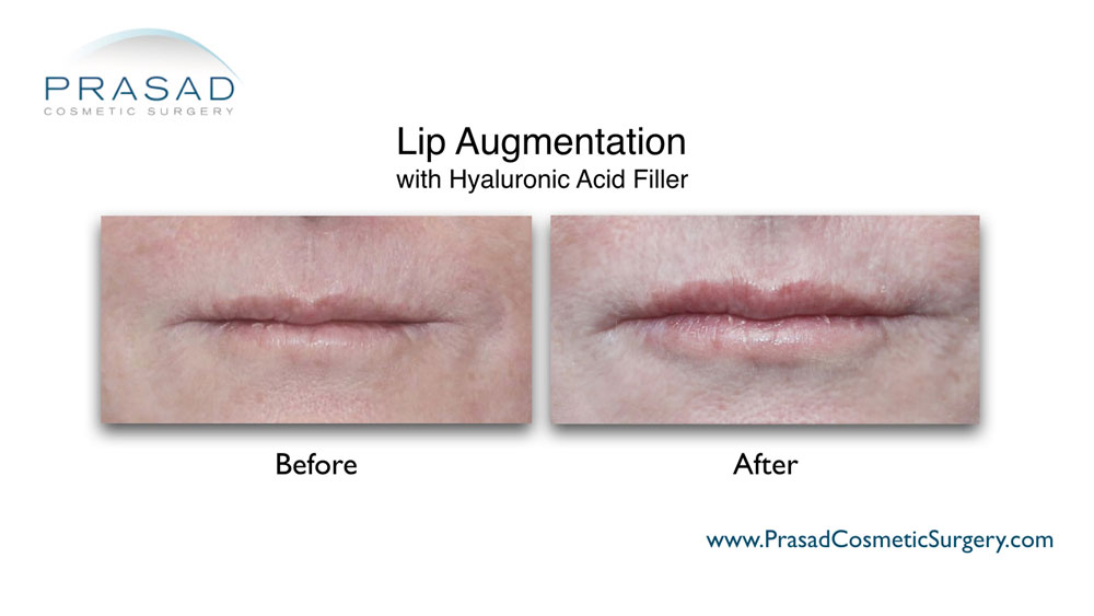 lip augmentation before and after treatment by Dr Amiya Prasad