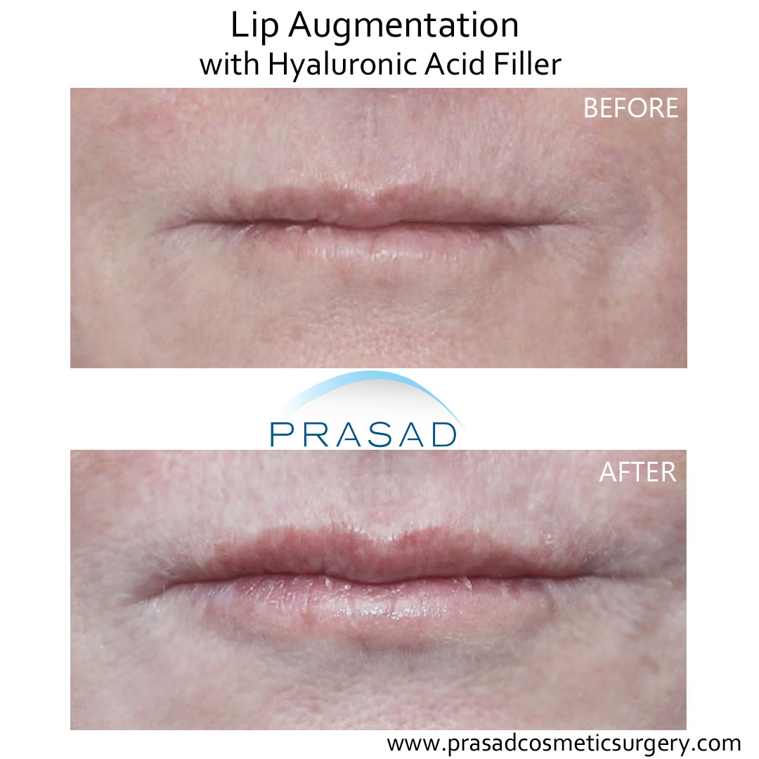 lip augmentation before and after treatment by Dr Amiya Prasad