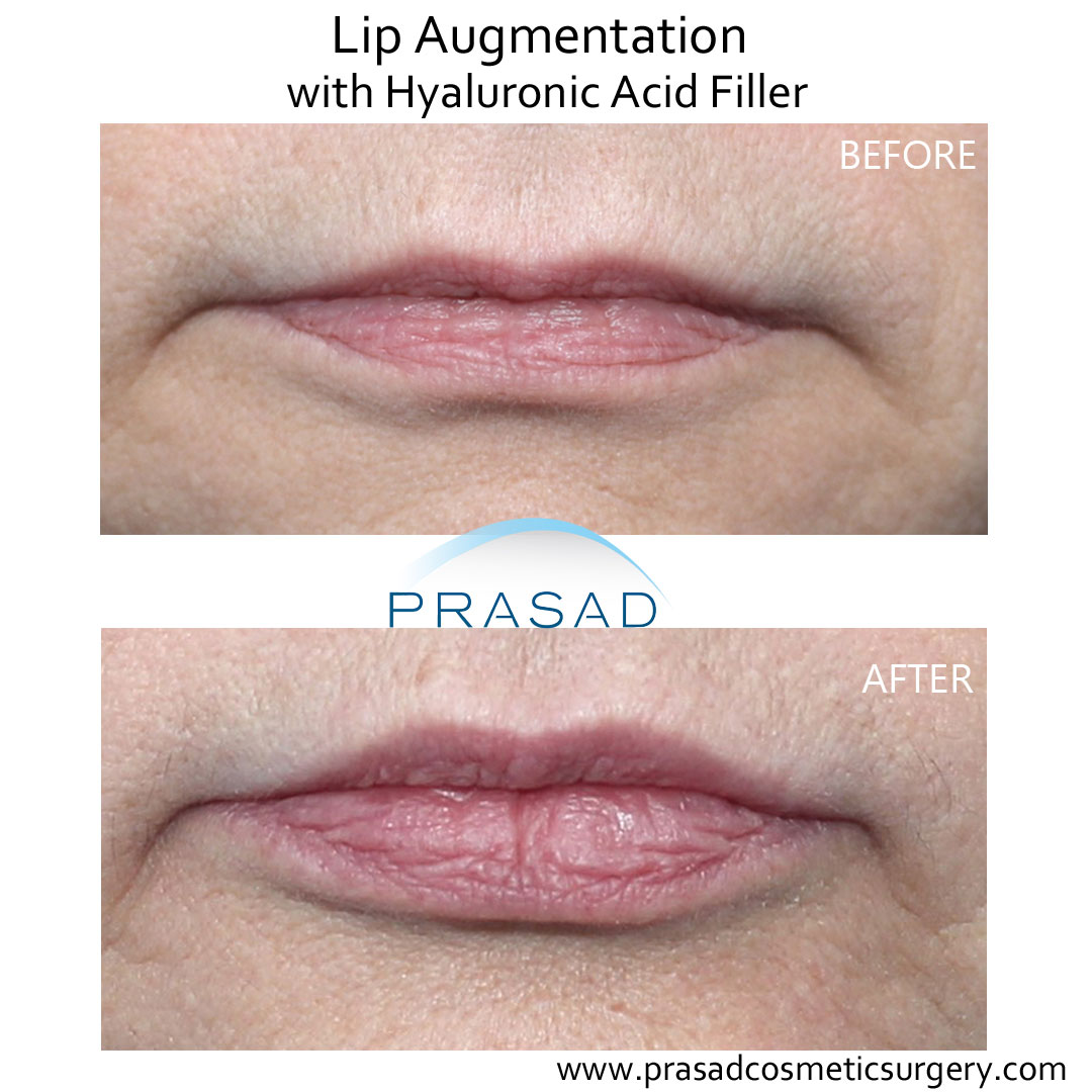 lip augmentation before and after - female patient