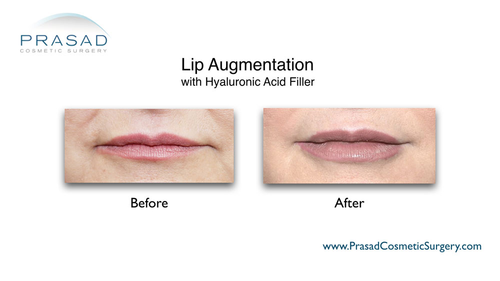 lip augmentation before and after treatment by Dr Amiya Prasad at NYC office