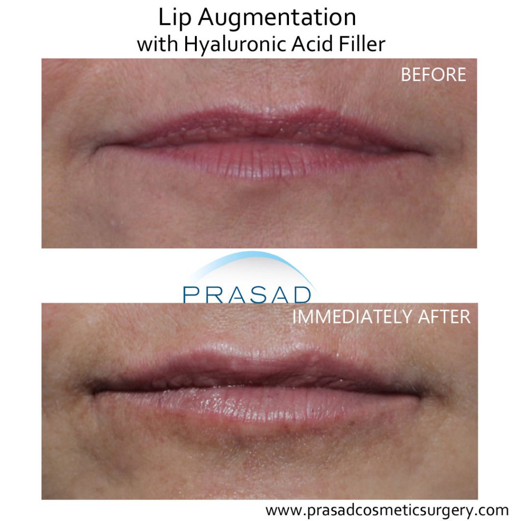 lip augmentation before and after - female patient - PSC Manhattan
