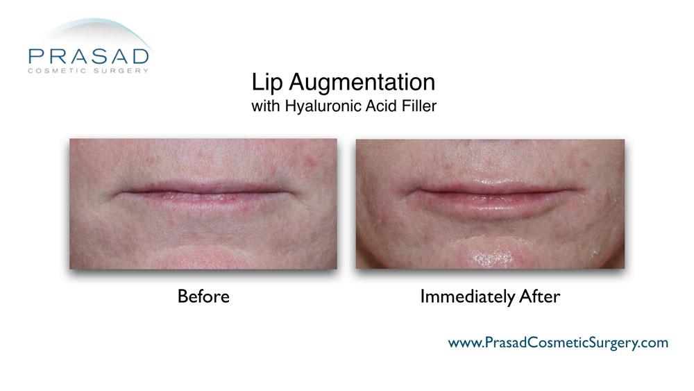 lip augmentation before and after - female patient - Garden City office