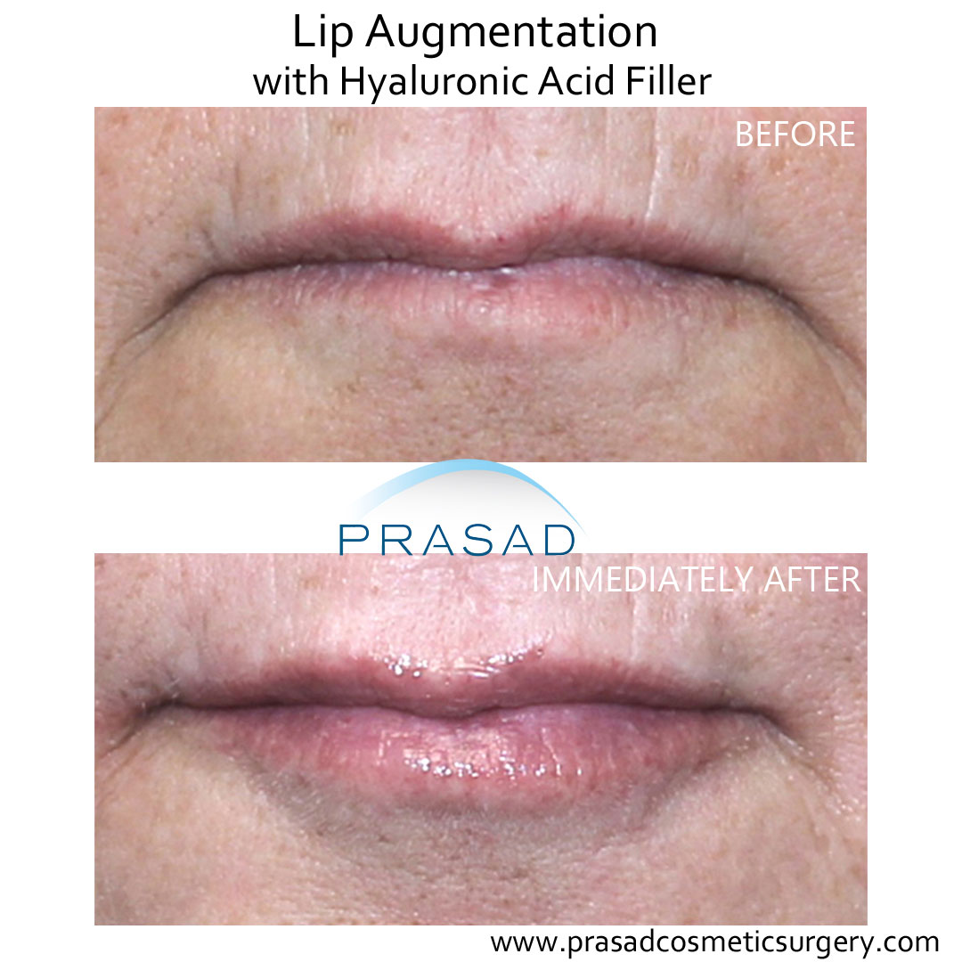 hyaluronic acid lip fillers before and after