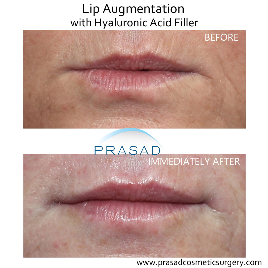 hyaluronic acid lip fillers before and after - Manhattan office