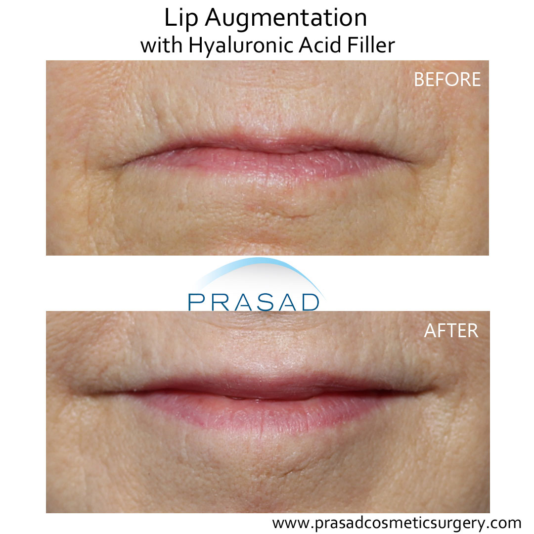 hyaluronic acid lip fillers before and after - Garden City office