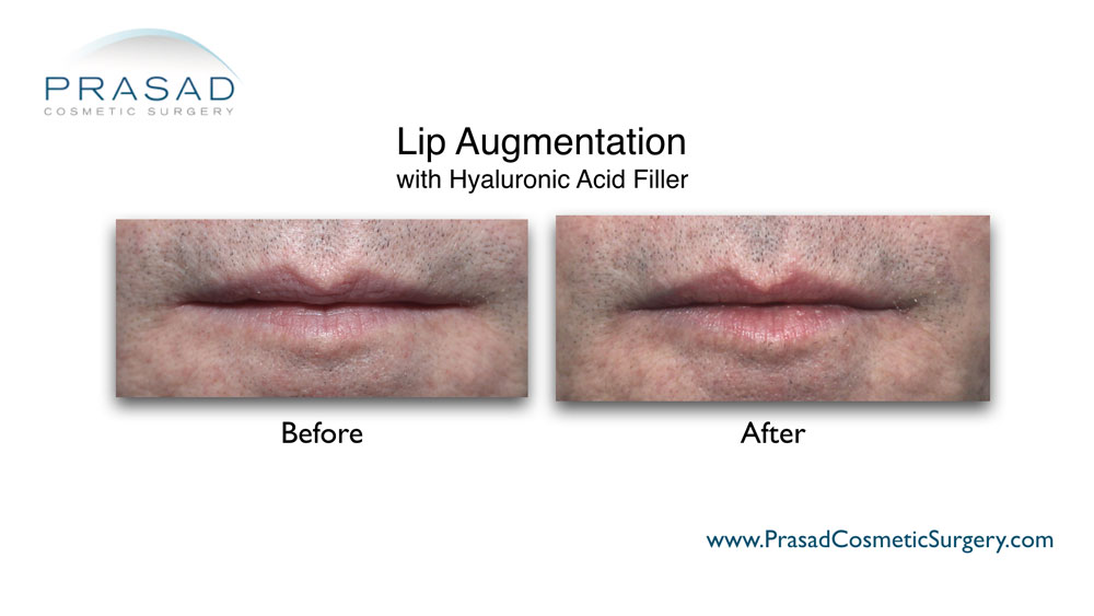 lip fillers before and after performed at Prasad Cosmetic Surgery Manhattan NYC