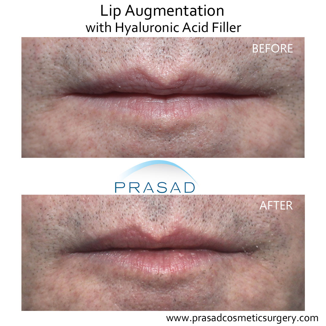 lip fillers before and after performed at Prasad Cosmetic Surgery Manhattan NYC
