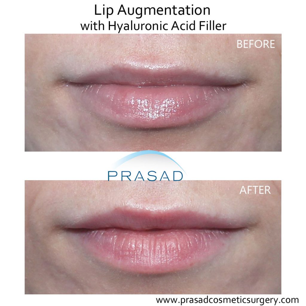 lip fillers before and after performed at Prasad Cosmetic Surgery Long Island