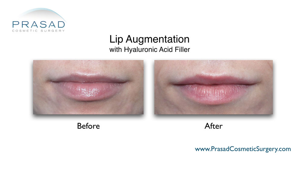 lip fillers before and after performed at Prasad Cosmetic Surgery Long Island