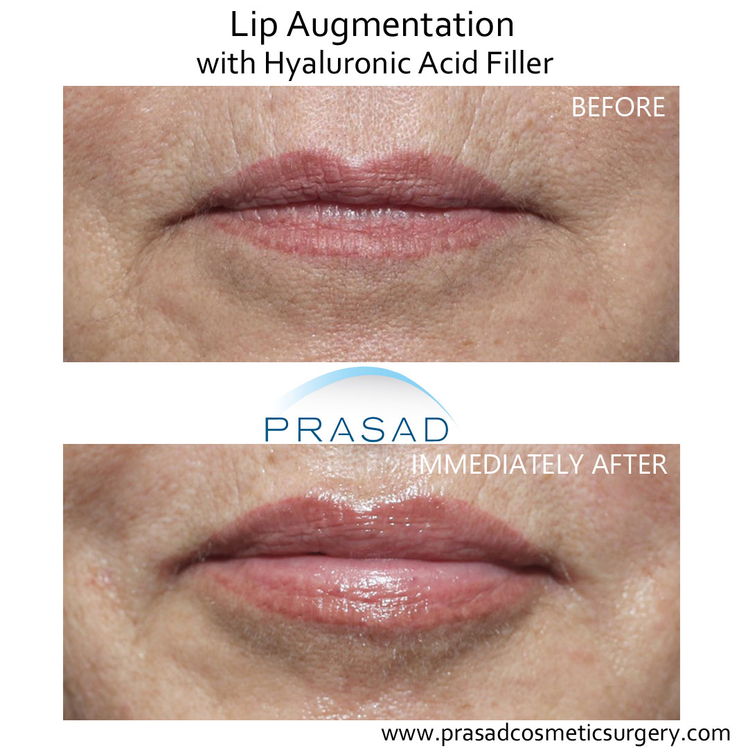 before and after lip augmentation procedure
