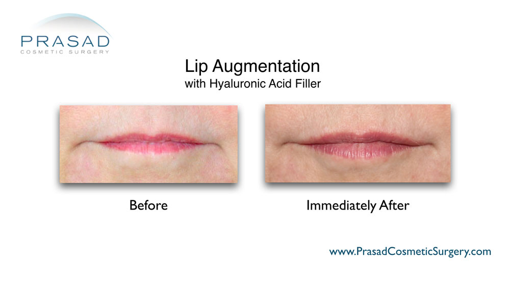 before and after lip augmentation treatment