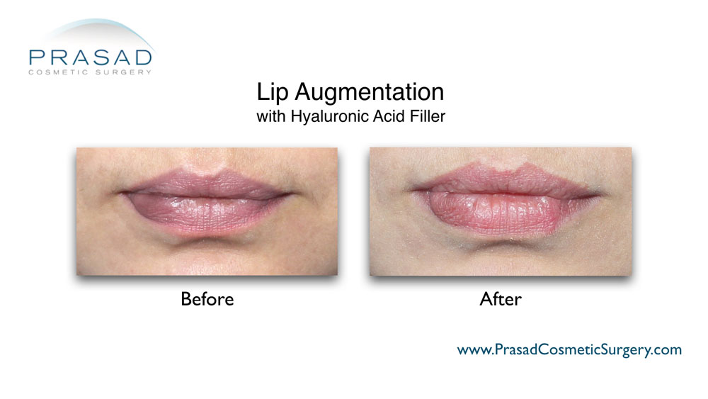 Juvederm lips before and after