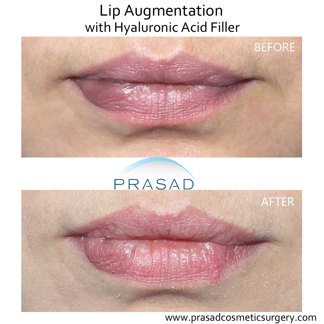Juvederm lips before and after