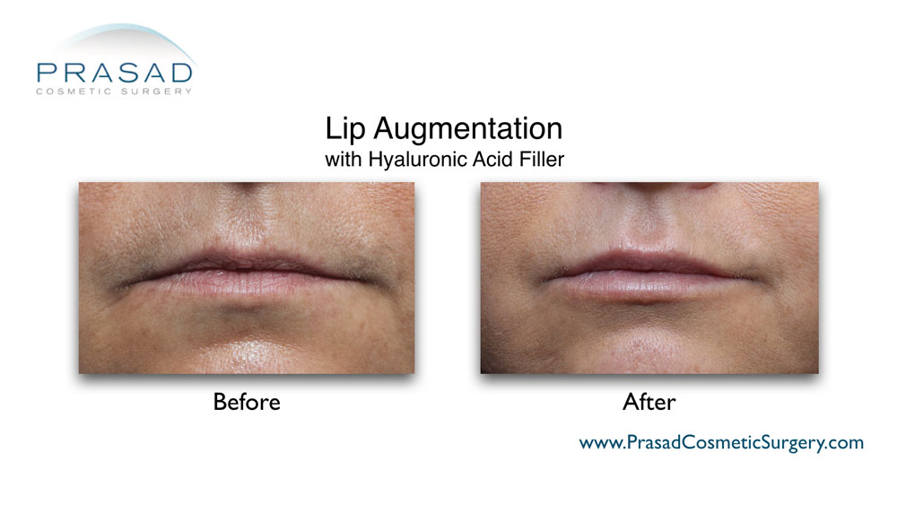 Juvederm lips before and after performed in Prasad Cosmetic Surgery Manhattan New York