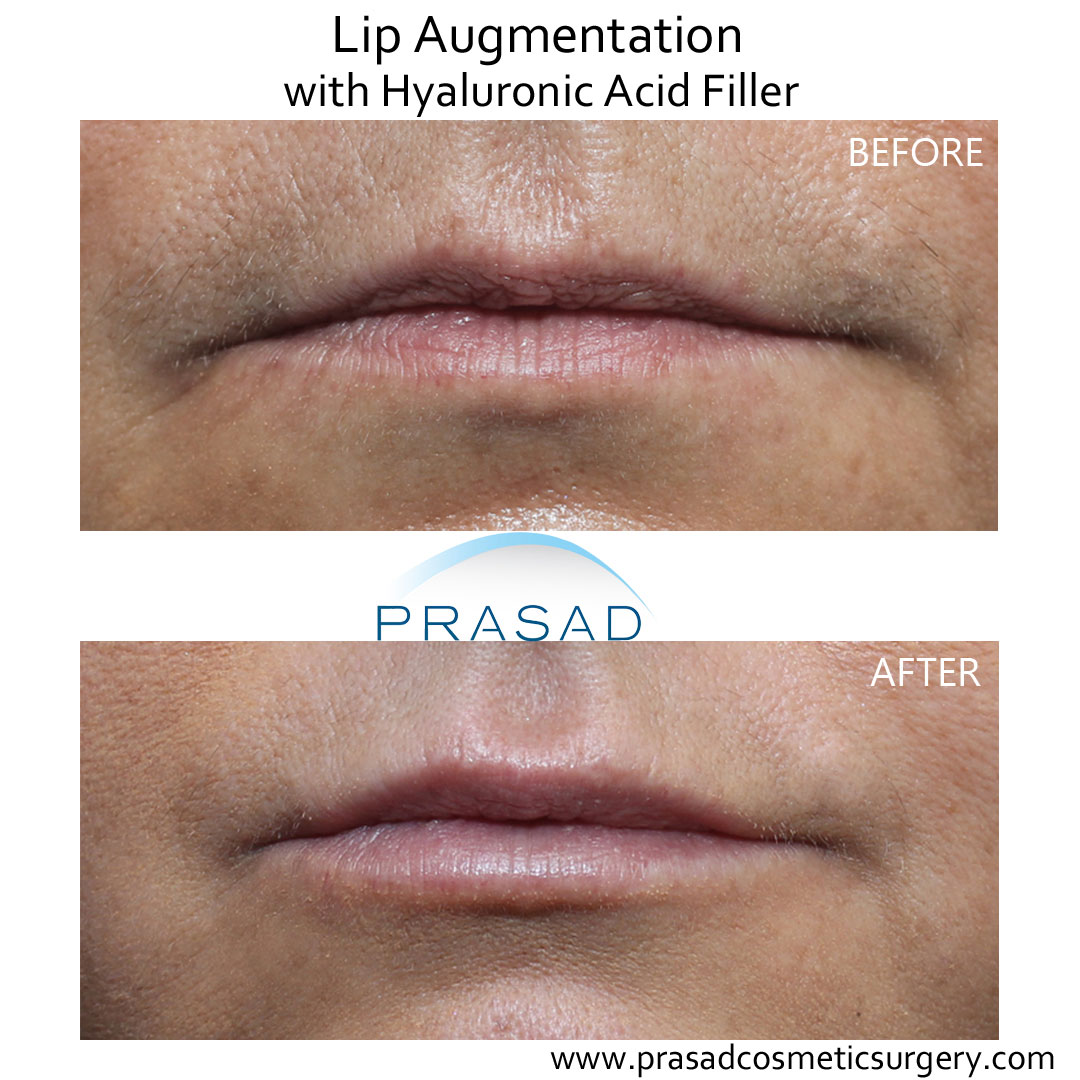 Juvederm lips before and after performed in Prasad Cosmetic Surgery Manhattan New York