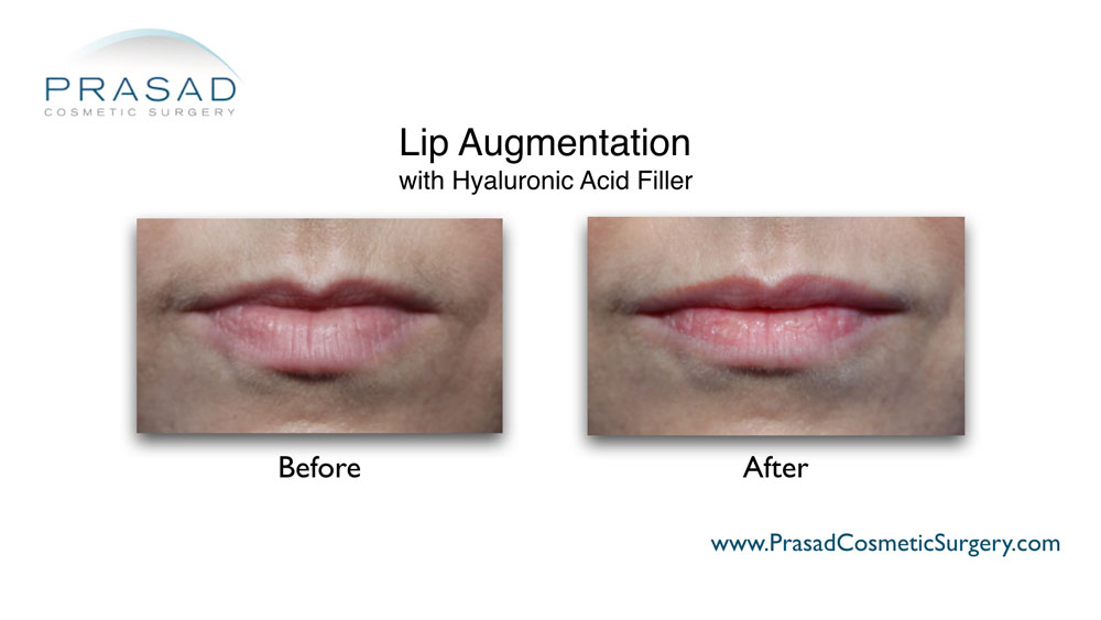 Juvederm lips before and after performed in Prasad Cosmetic Surgery Long Island
