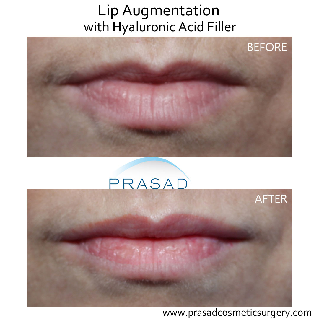 Juvederm lip fillers before and after performed in Prasad Cosmetic Surgery Long Island