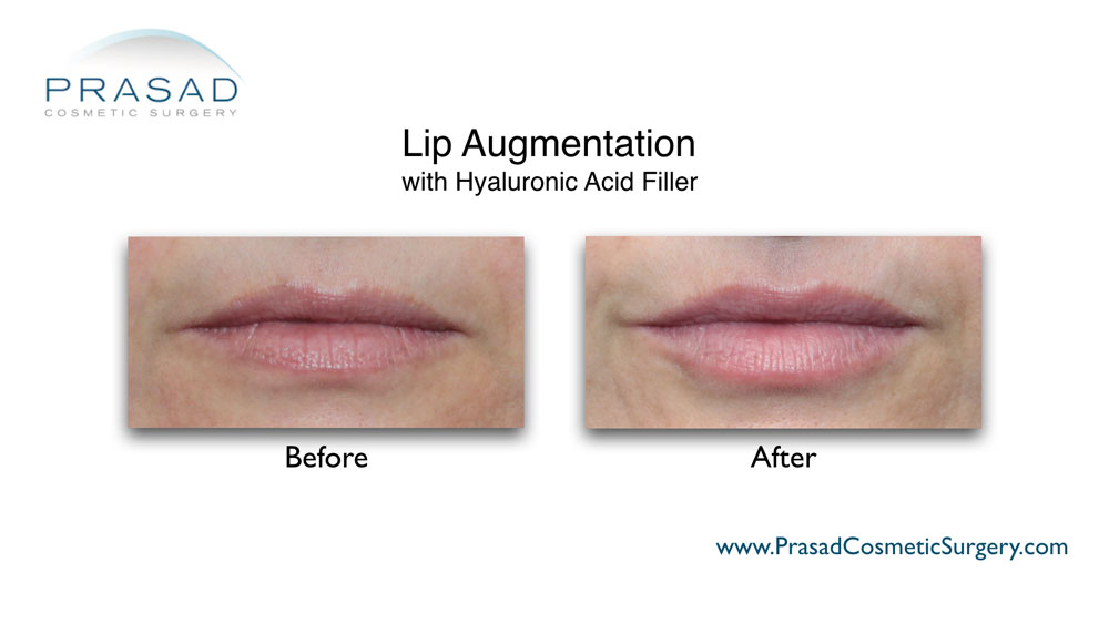 Juvederm lips before and after performed in Prasad Cosmetic Surgery New York City