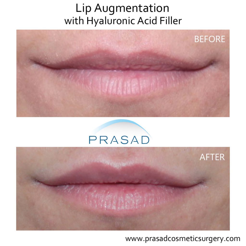 lip augmentation before and after