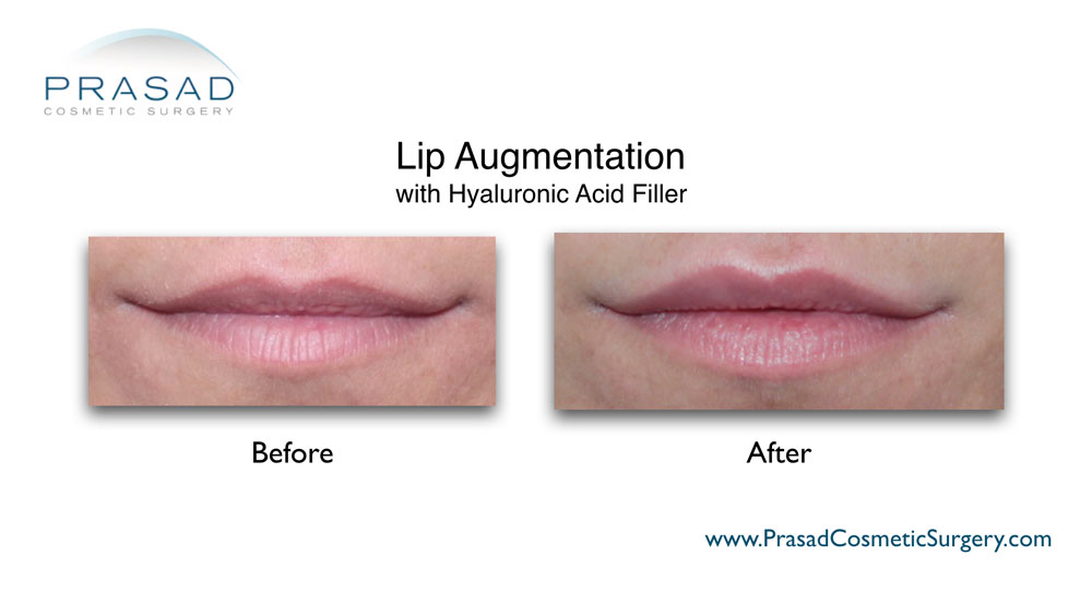 lip augmentation before and after