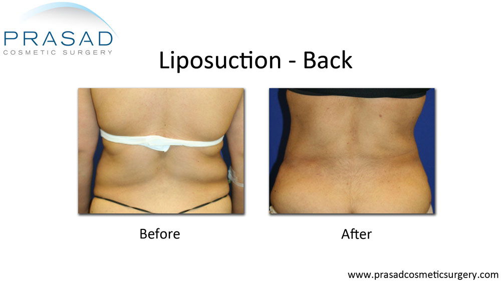 liposuction back fat before and after