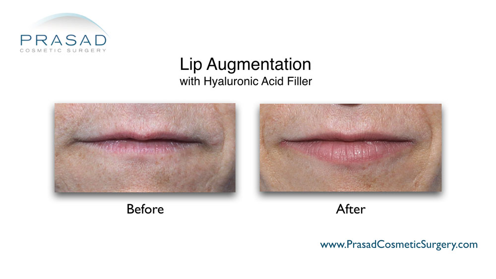 male lip augmentation before and after