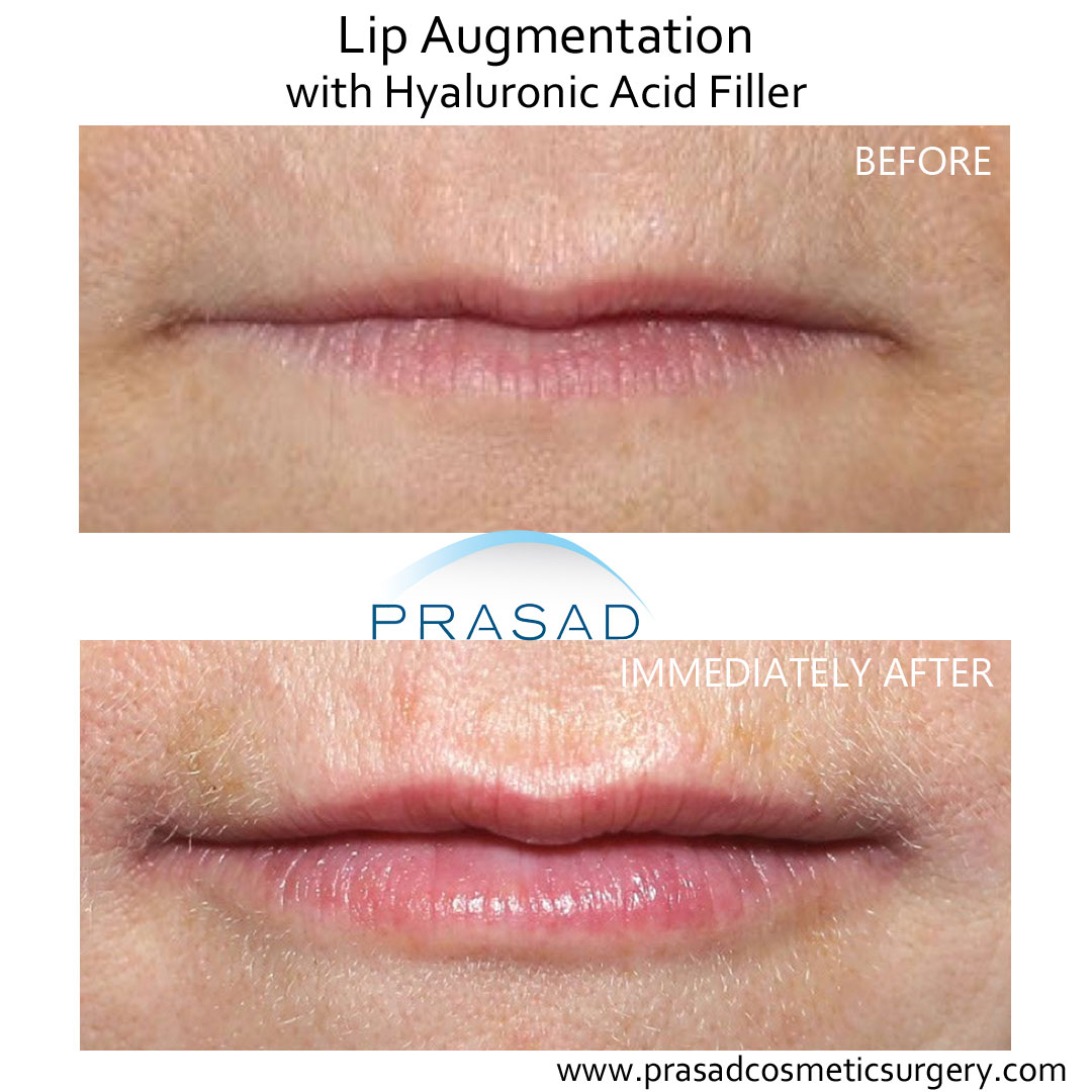hyaluronic acid lip fillers before and after