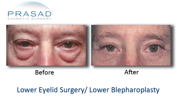 old male lower blepharoplasty before and after