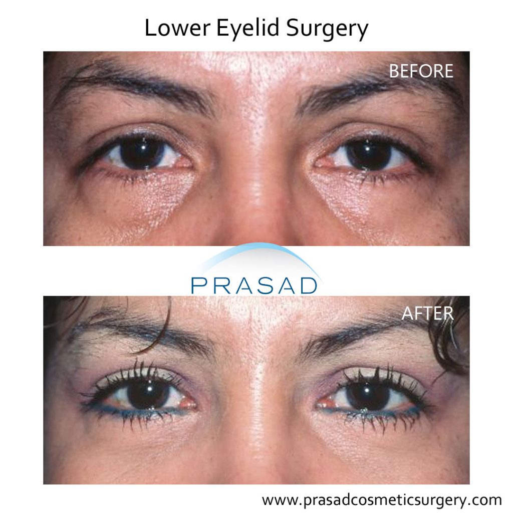 lower eyelid plastic surgery before after