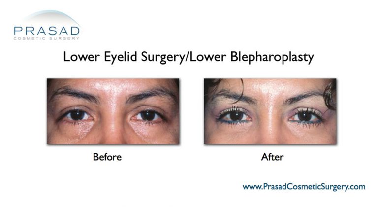 Transconjunctival Blepharoplasty | Eyelid surgery - New York City