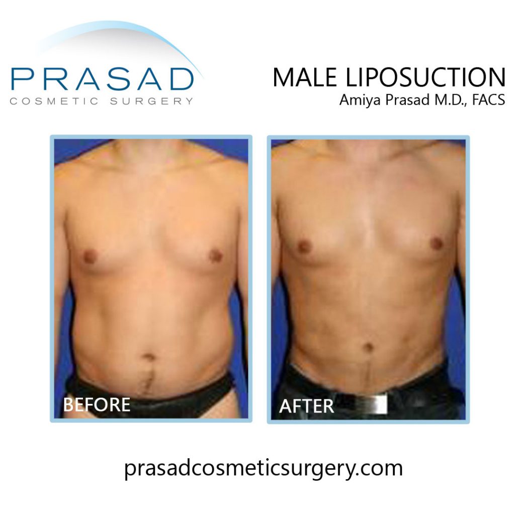 male liposuction before and after