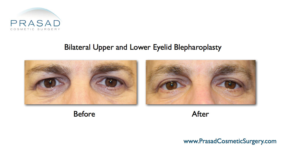Upper Blepharoplasty Before and After Photos | Gallery