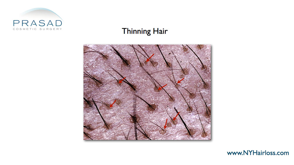 microscope image of thinning hair
