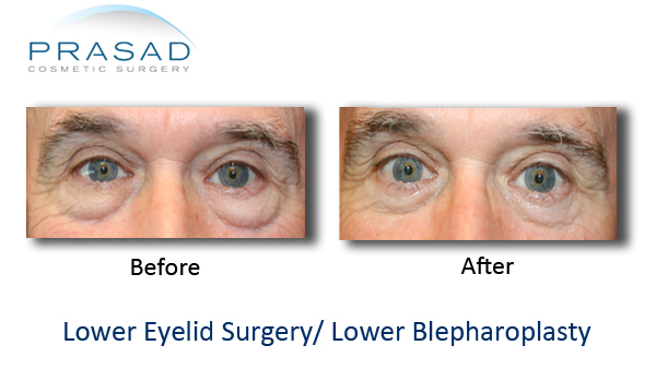 ole male lower eyelid surgery before and after