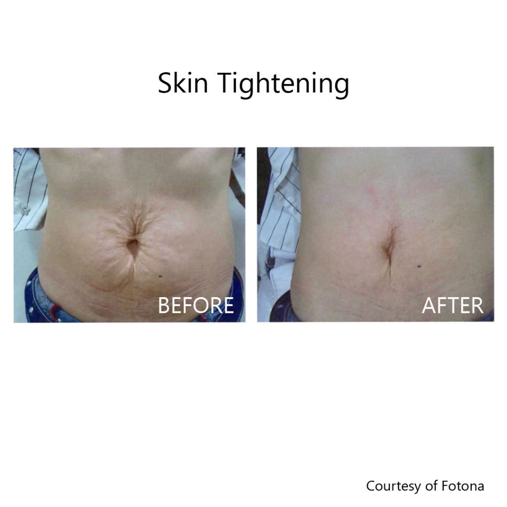Stretch marks from post-pregnancy before and after laser skin tightening