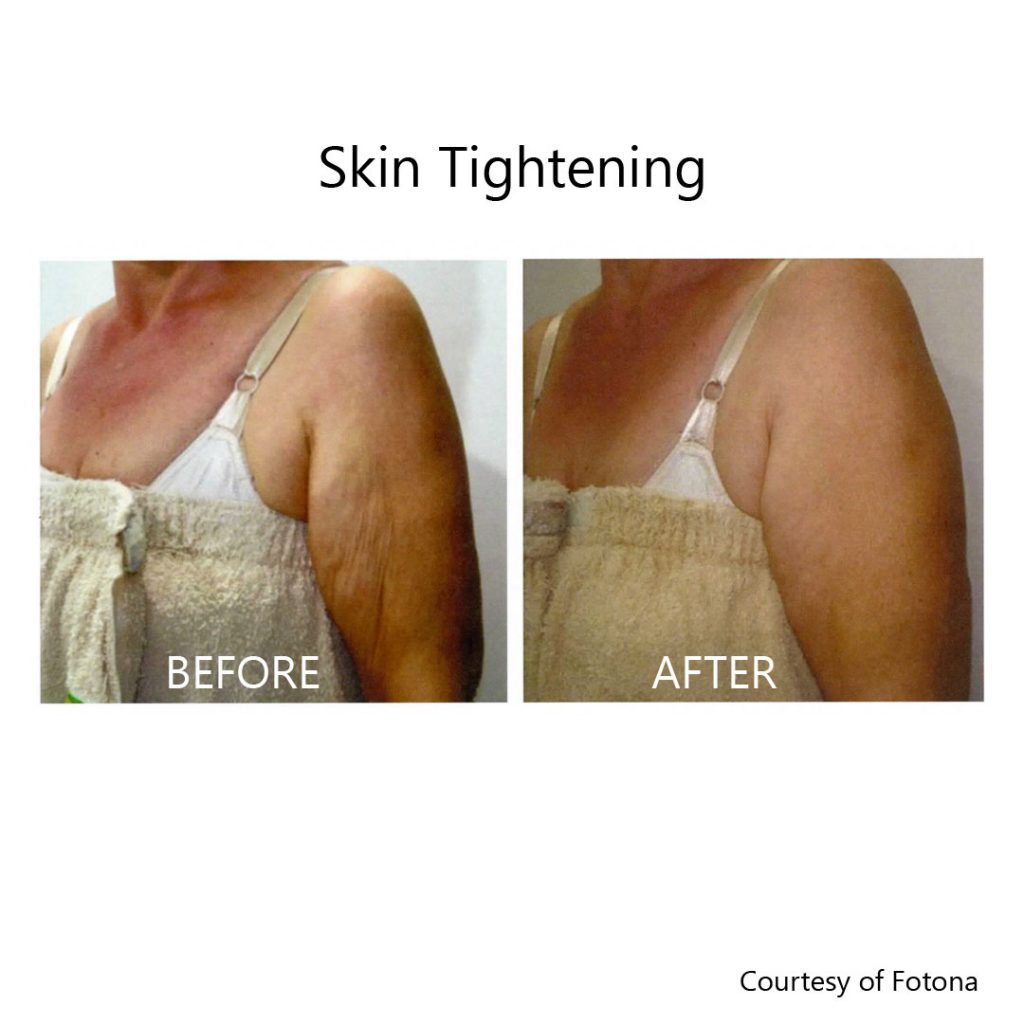 skin tightening arms before and after