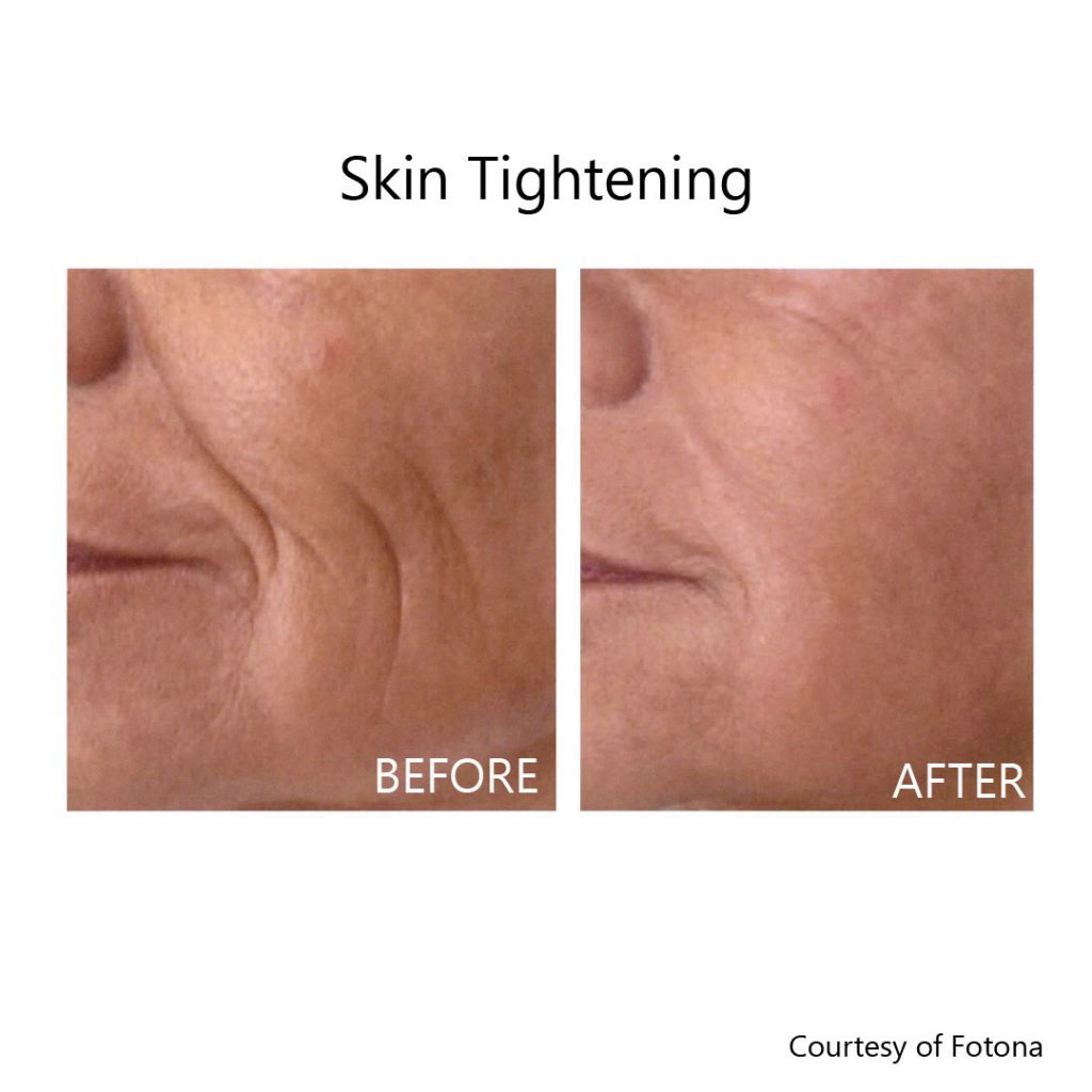 skin tightening face before and after