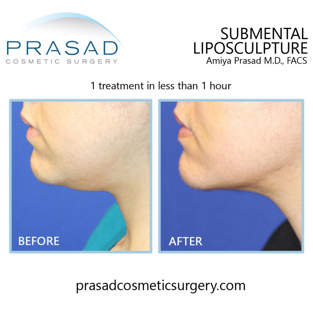 submental liposuction before and after