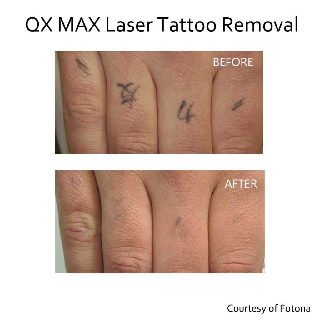 before and after Laser tattoo removal