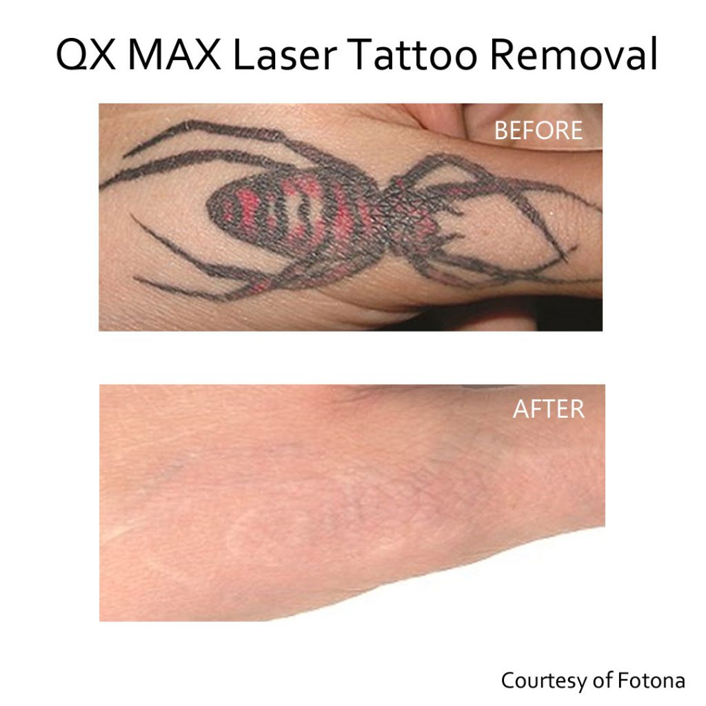 Eraze-ink laser tattoo removal | Bury