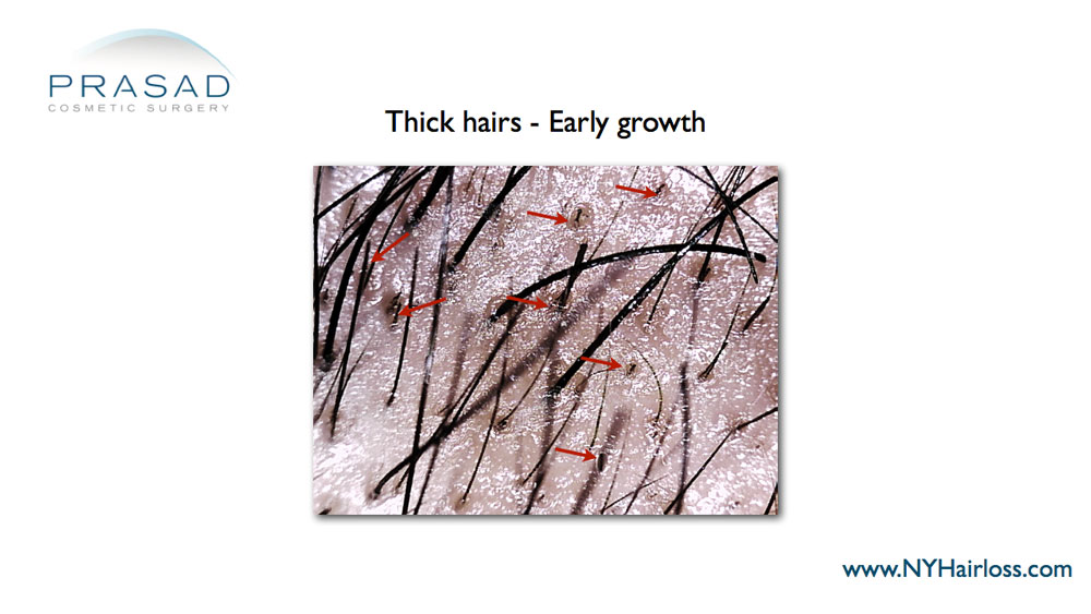 microscope image of Thicker hair after hair regeneration injection on thinning hair