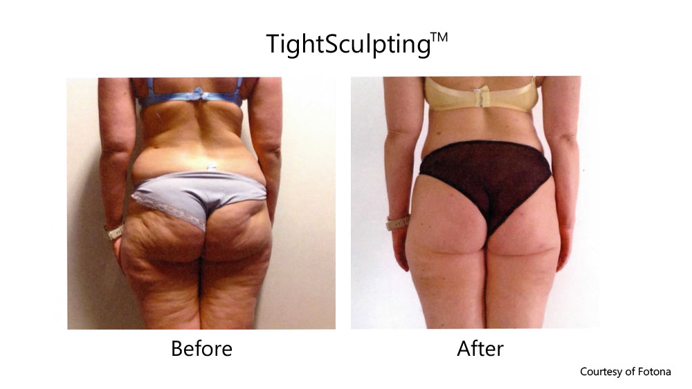 Cellulite and fat reduction before and after