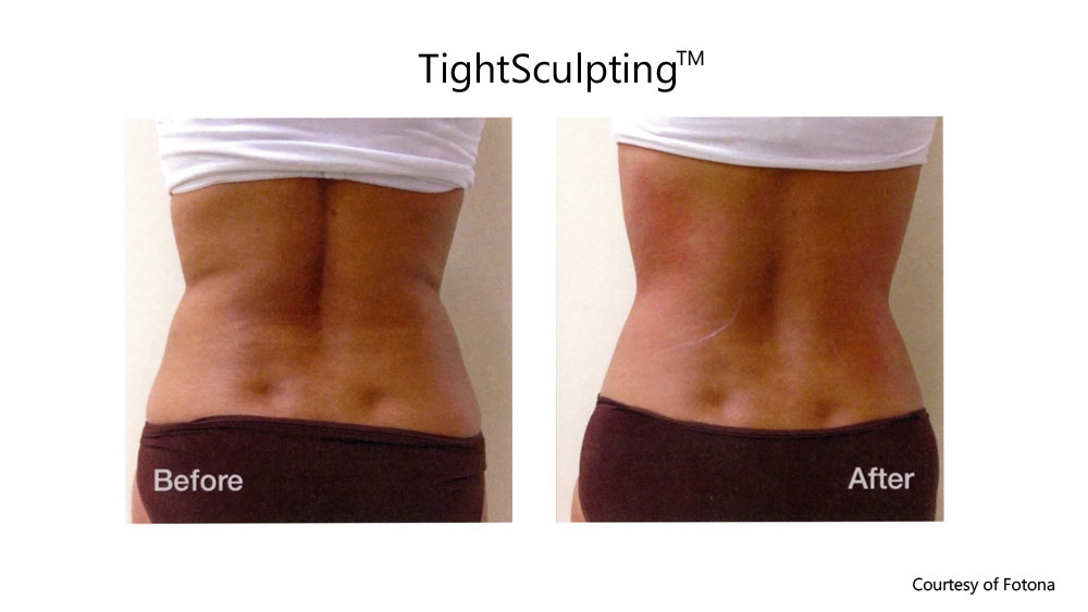 Non-Surgical Fat Reduction before and after