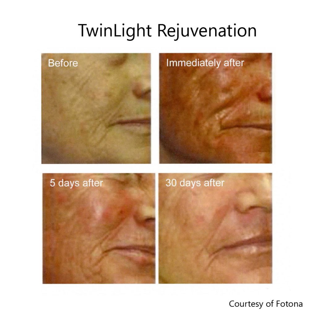 Fully ablative laser skin tightening before, immediately after and 30 days after results