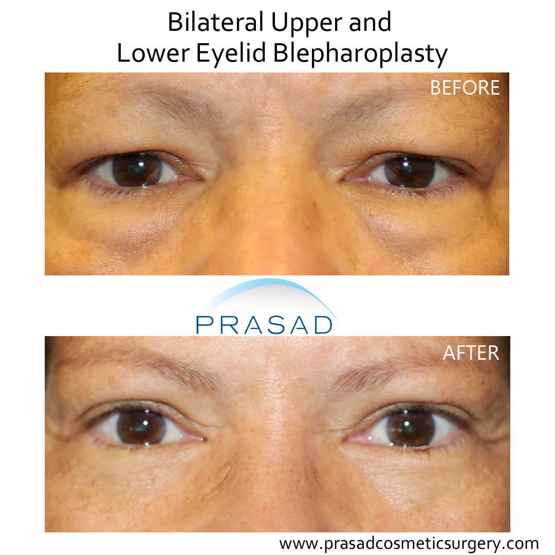 upper and lower blepharoplasty before and after performed in Prasad Cosmetic Surgery Garden City office