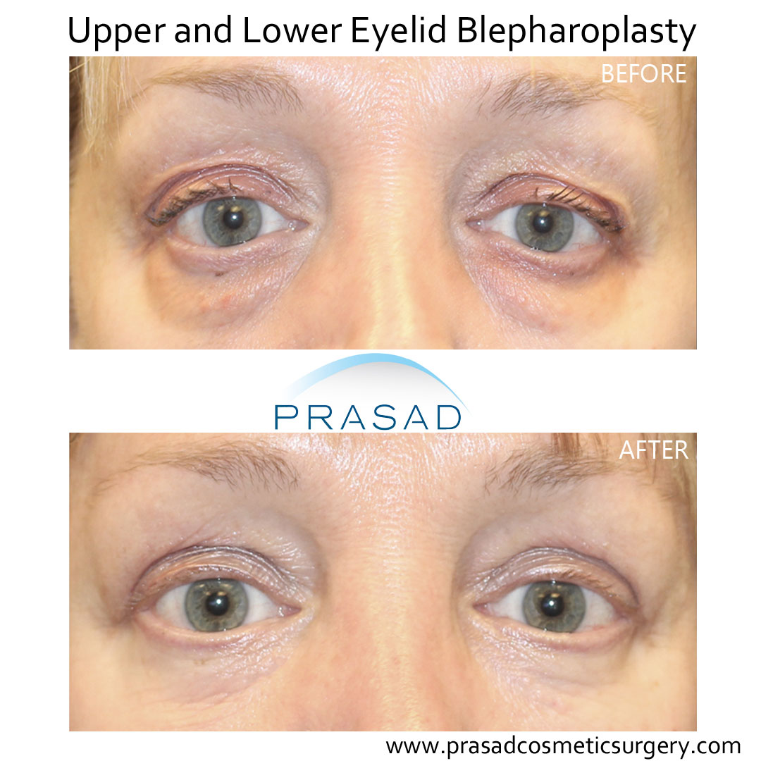 male upper and lower blepharoplasty before and after performed in Prasad Cosmetic Surgery Manhattan office