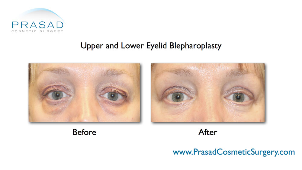 female upper and lower blepharoplasty before and after performed in Prasad Cosmetic Surgery Manhattan office